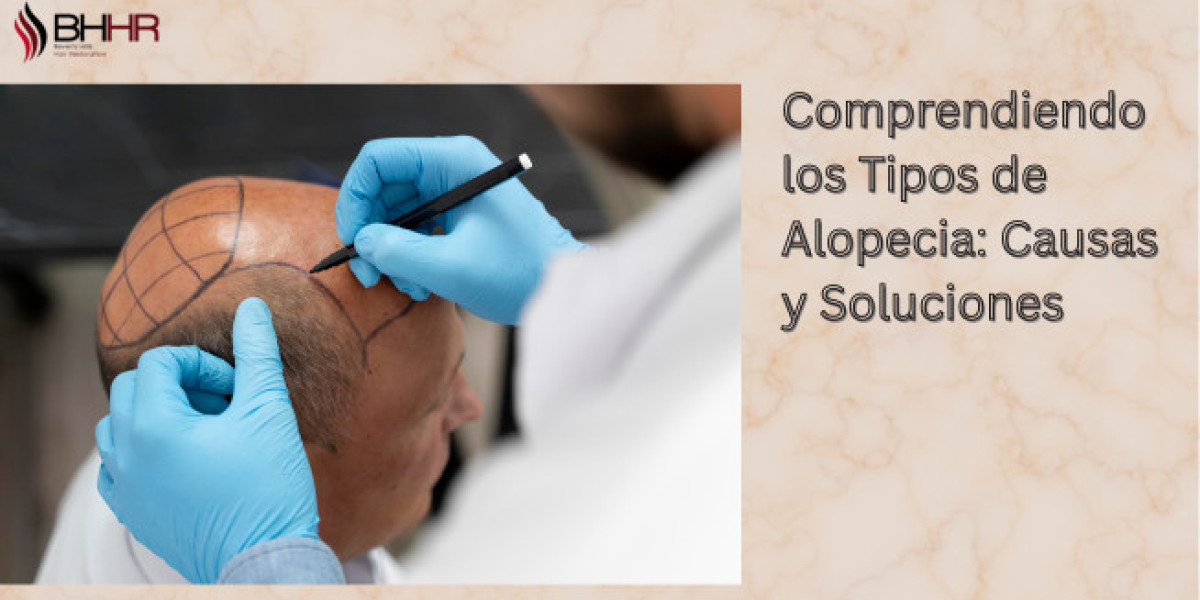 Comprendiendo los Tipos de Alopecia: Causas y Soluciones