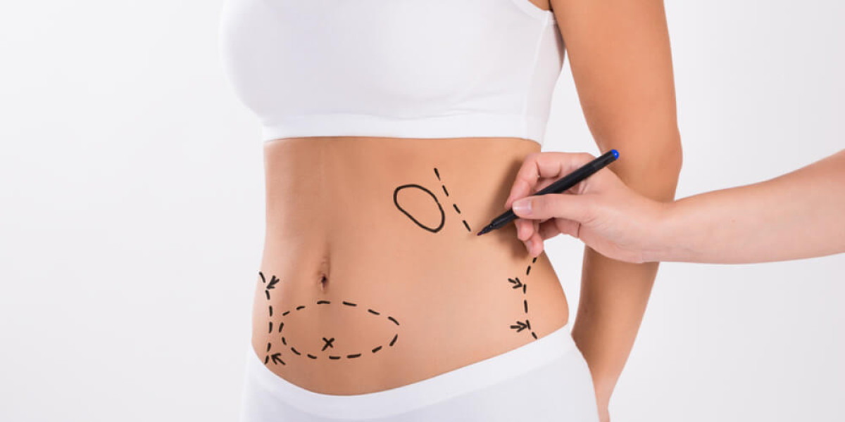 Liposuction Tips from the Best Liposuction Surgeon in Dubai
