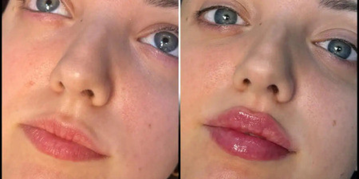 Fillers in Dubai for Anti-Aging: Do They Work?
