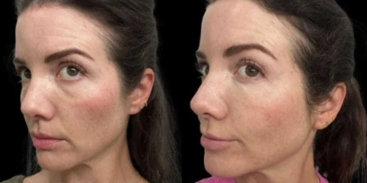 Top 10 Proven Dark Circles Treatments in Dubai for Brighter Eyes