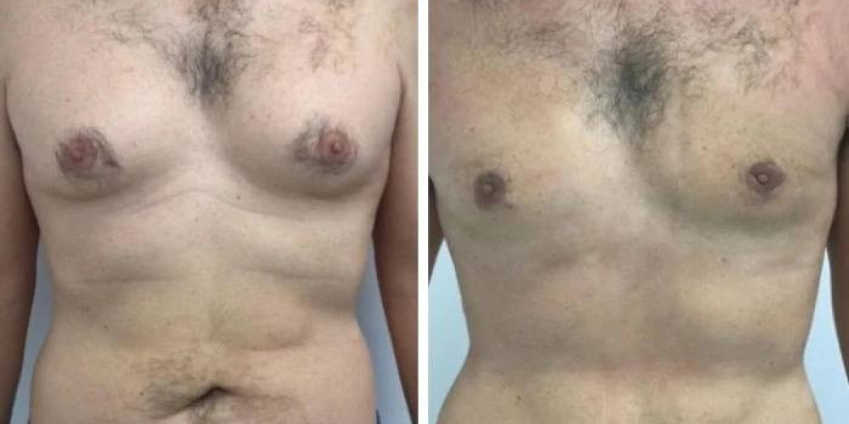 Best Doctors in Dubai: Gynecomastia Myths and Facts