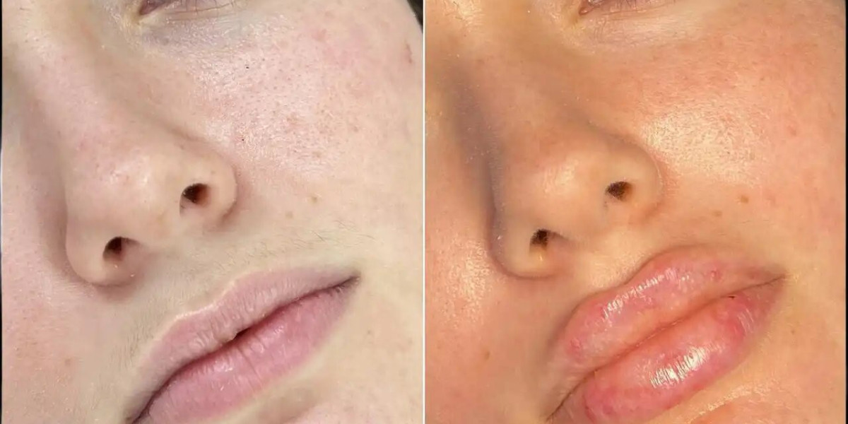 Fillers Treatment in Dubai: What to Expect After Treatment