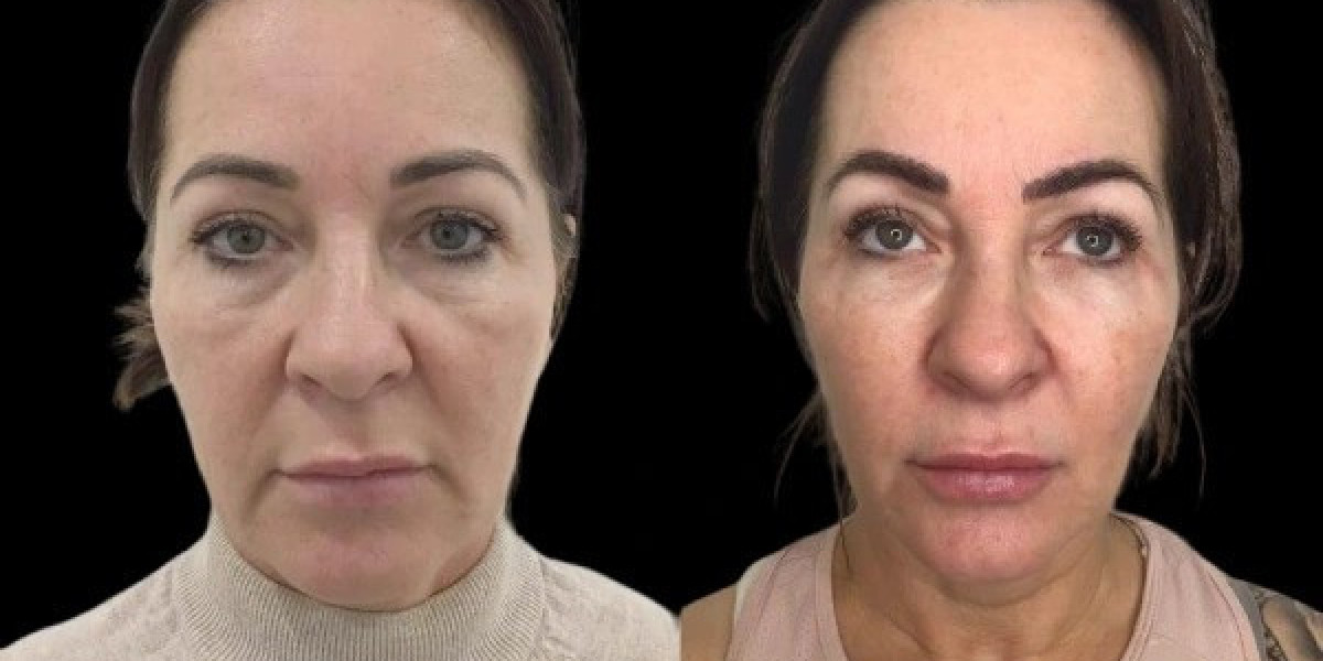 Profhilo Treatments in Dubai for Sensitive Skin Can They Help You
