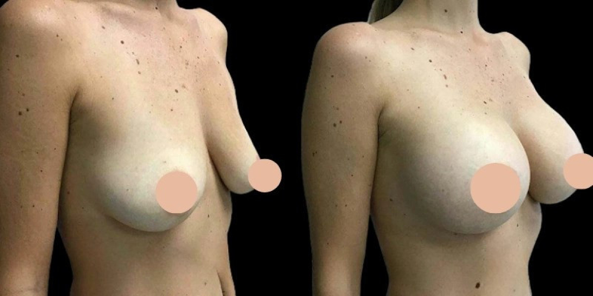 Breast Augmentation in Dubai: Exploring the Most Natural-Looking Results