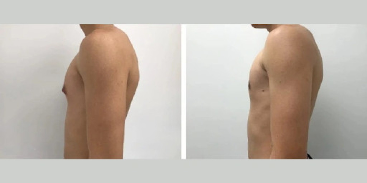 How the Best Gynecomastia Surgeons in Dubai Achieve Natural, Symmetrical Results
