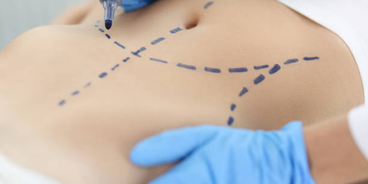 Preparing Your Home Environment for Liposuction Surgery Recovery