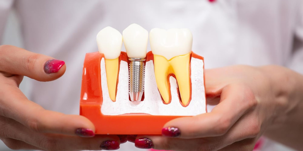 Elevate Bold Beauty Instantly With Dental Implants in Dubai Today