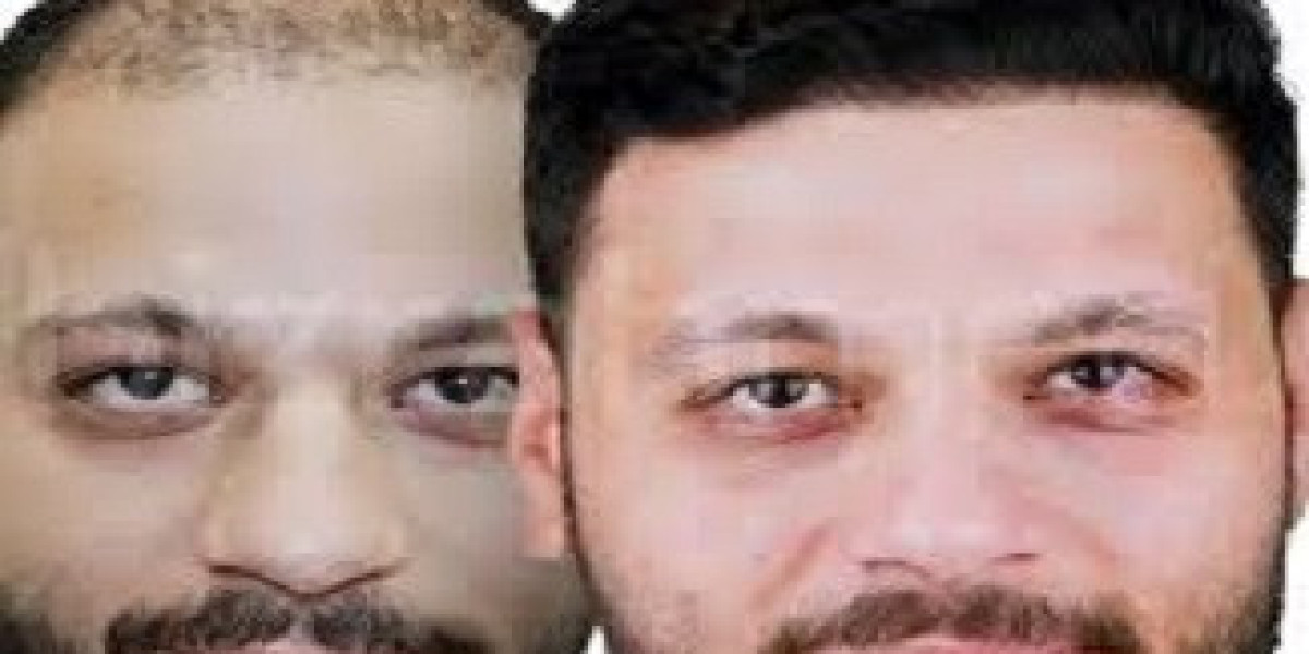Transformative Hair Transplant Experiences in Riyadh