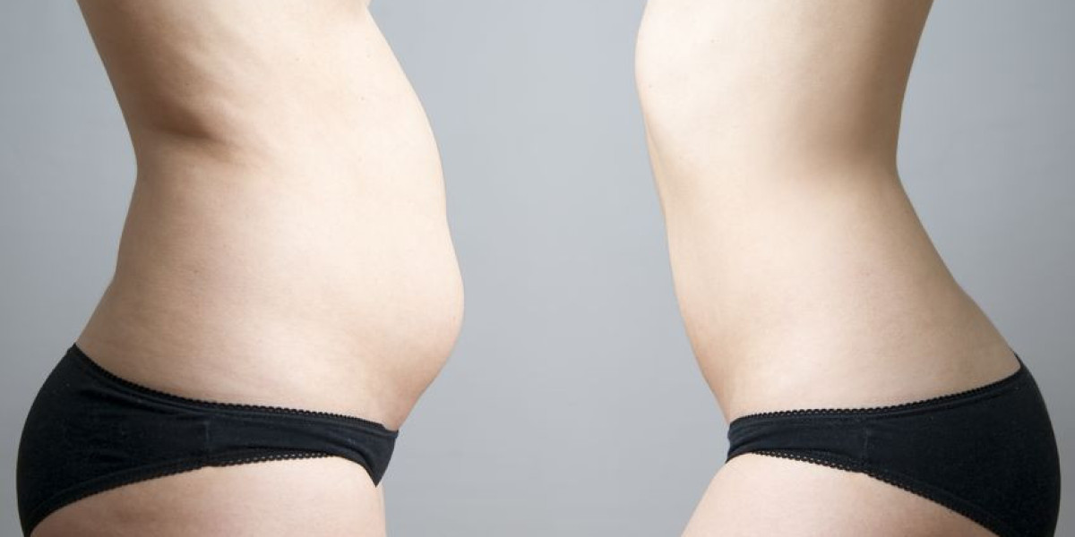 Center‑Body Precision and Style with a Tummy Tuck