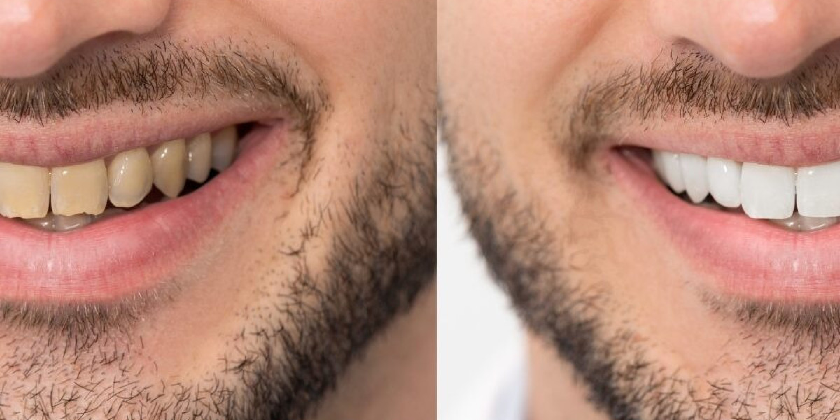 Teeth Whitening in Dubai for a Bright Polished Look You Will Appreciate