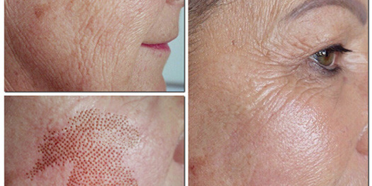 Plasma Pen Treatment That Redefines Modern Skin Rejuvenation